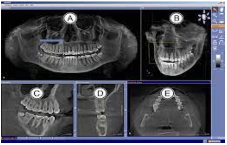 Analysis of Artefacts in Endodontically Treated Teeth on Cone Beam ...