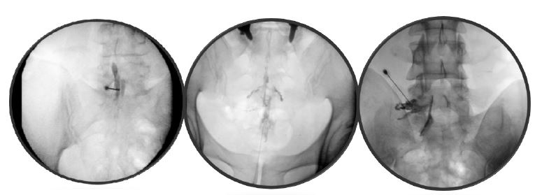 Lumbar Epidural Steroid Injection in Elderly Patients: A Mini Review